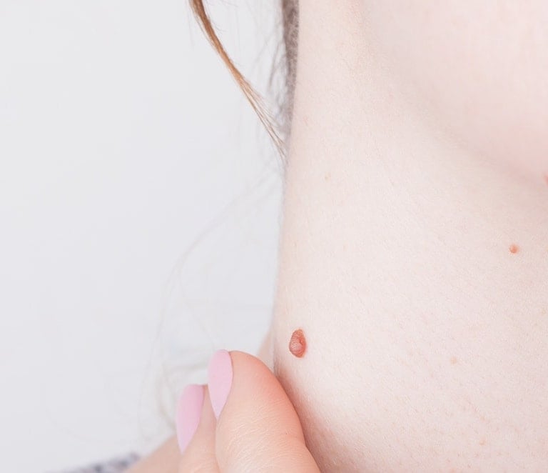 Warts Removal