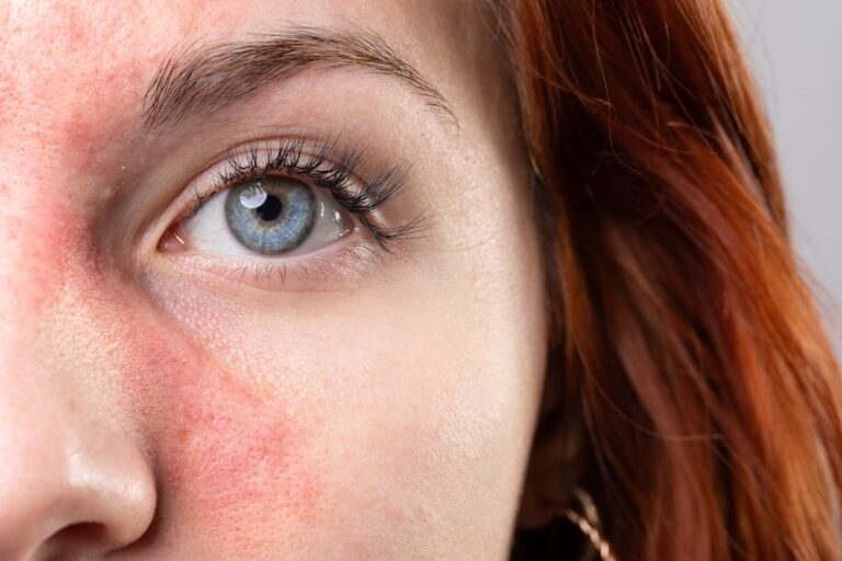 Rosacea