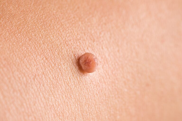 Skin tags