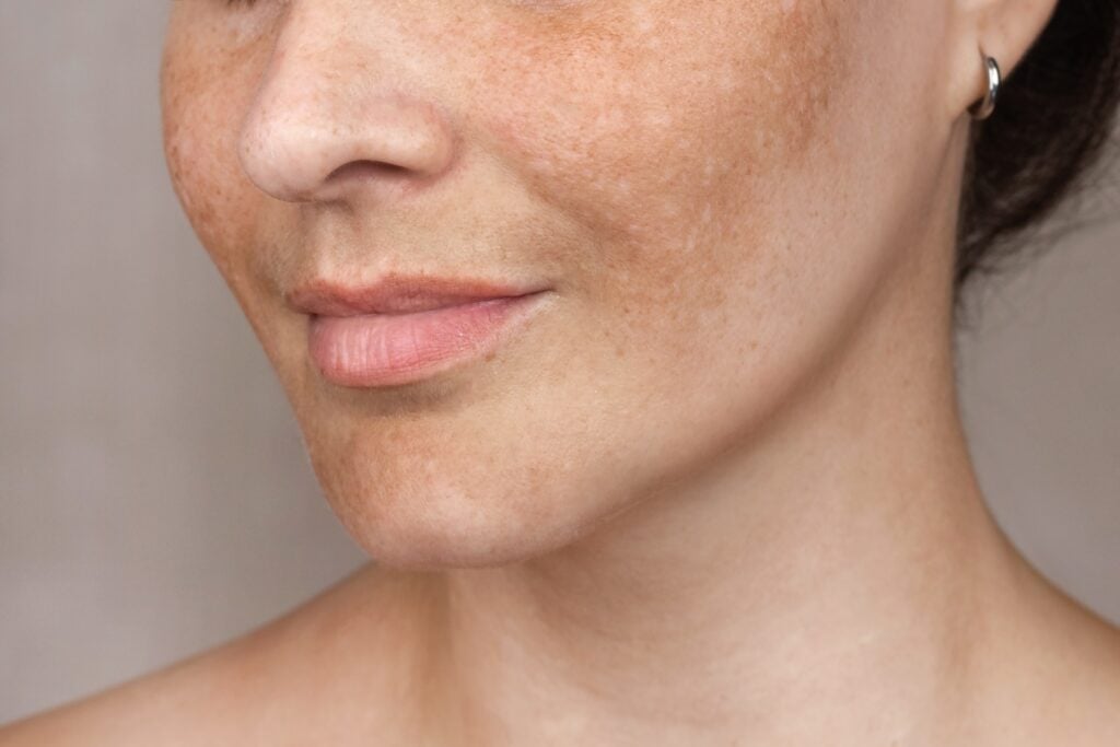 Knight Dermatology - Hyperpigmentation